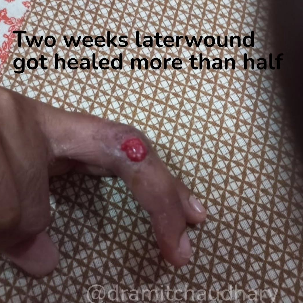 During 2nd Psoriasis