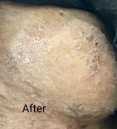 During Psoriasis