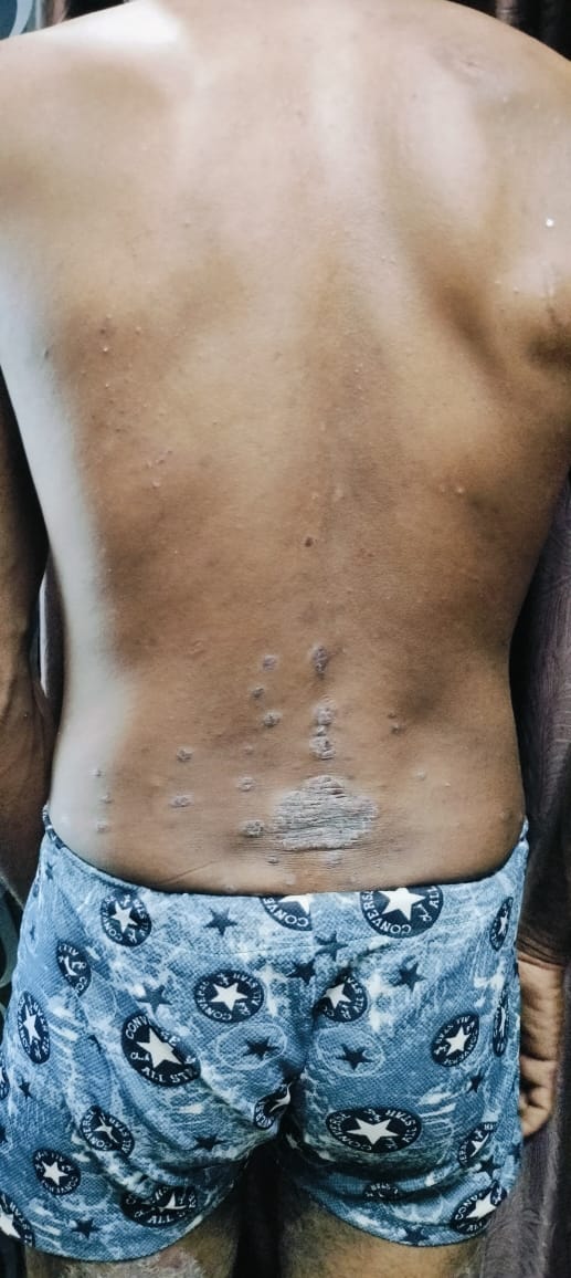 During 2nd Psoriasis