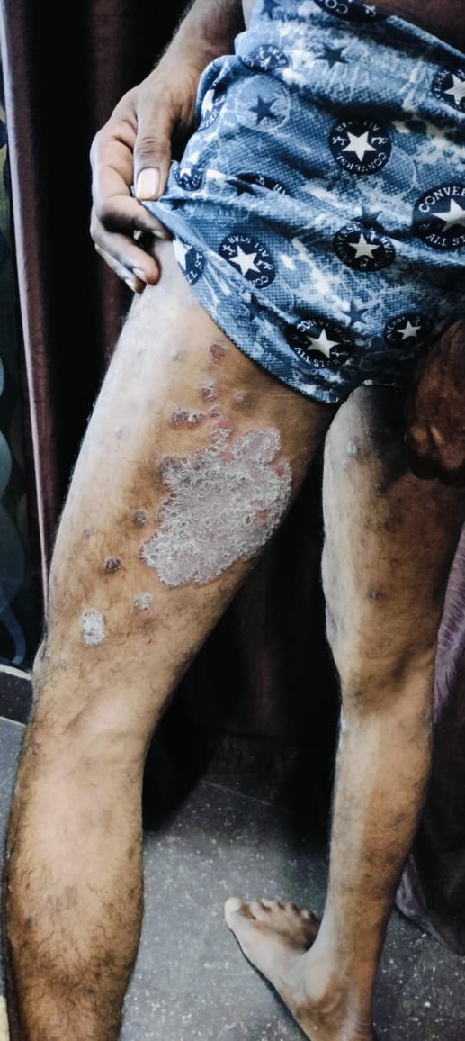 During 4th Psoriasis