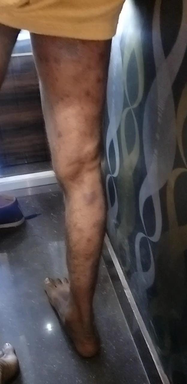 During 5th Psoriasis