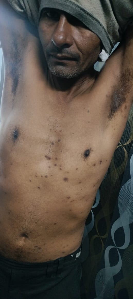 During 6th Psoriasis